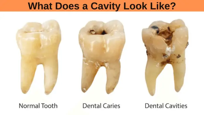 What Does a Cavity Look Like