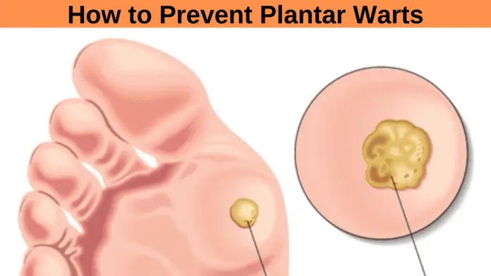 How to Prevent Plantar Warts