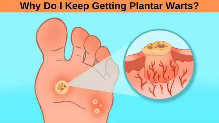 Why Do I Keep Getting Plantar Warts