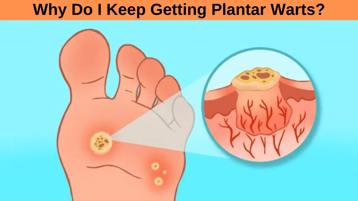 why-do-i-keep-getting-plantar-warts-myhealthgeek