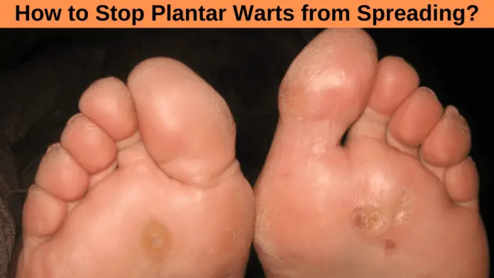 How to Stop Plantar Warts from Spreading