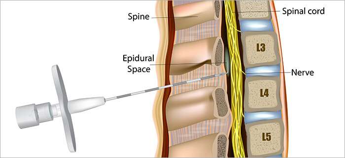 Types of Injections for Back Pain