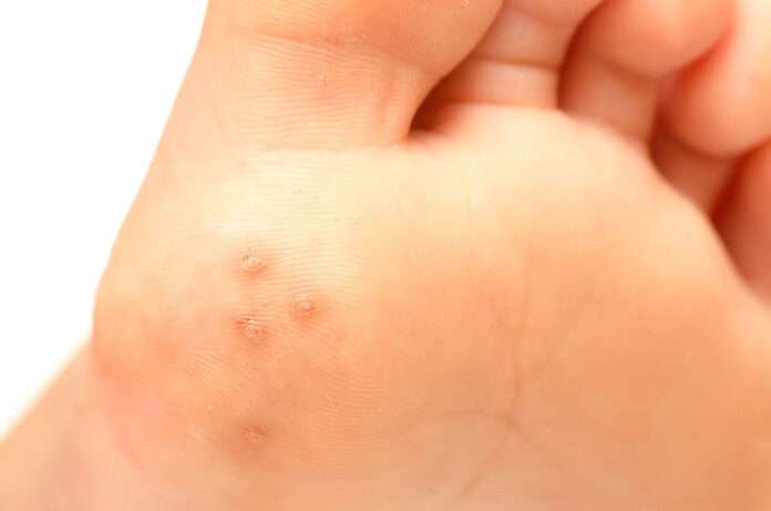 Do Plantar Warts Go Away on Their Own?