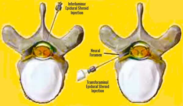 Types of Injections for Back Pain