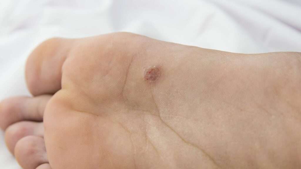 Do Plantar Warts Go Away on Their Own