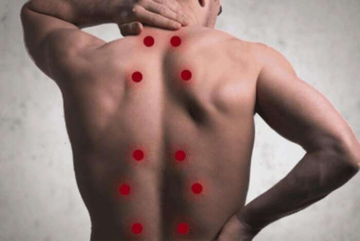 Trigger Point Injections