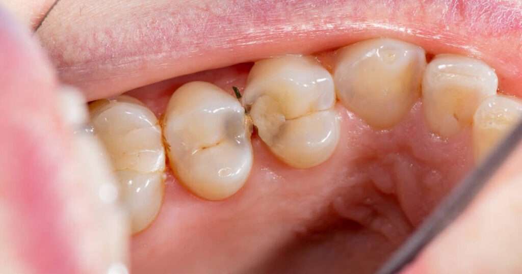 What Does A Cavity Look Like When It First Starts