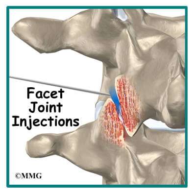 Types of Injections for Back Pain