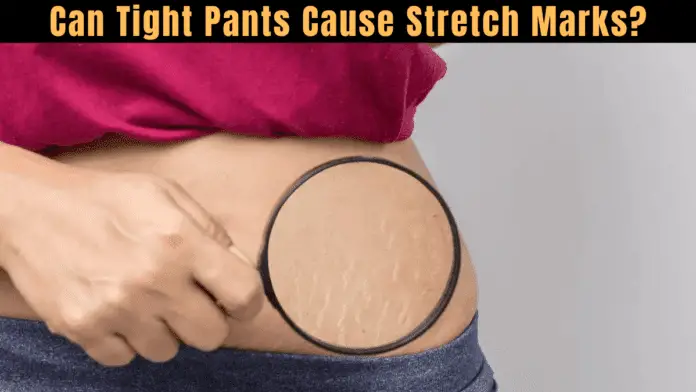 Can Tight Pants Cause Stretch Marks?