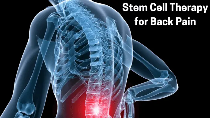 Stem Cell Therapy for Back Pain