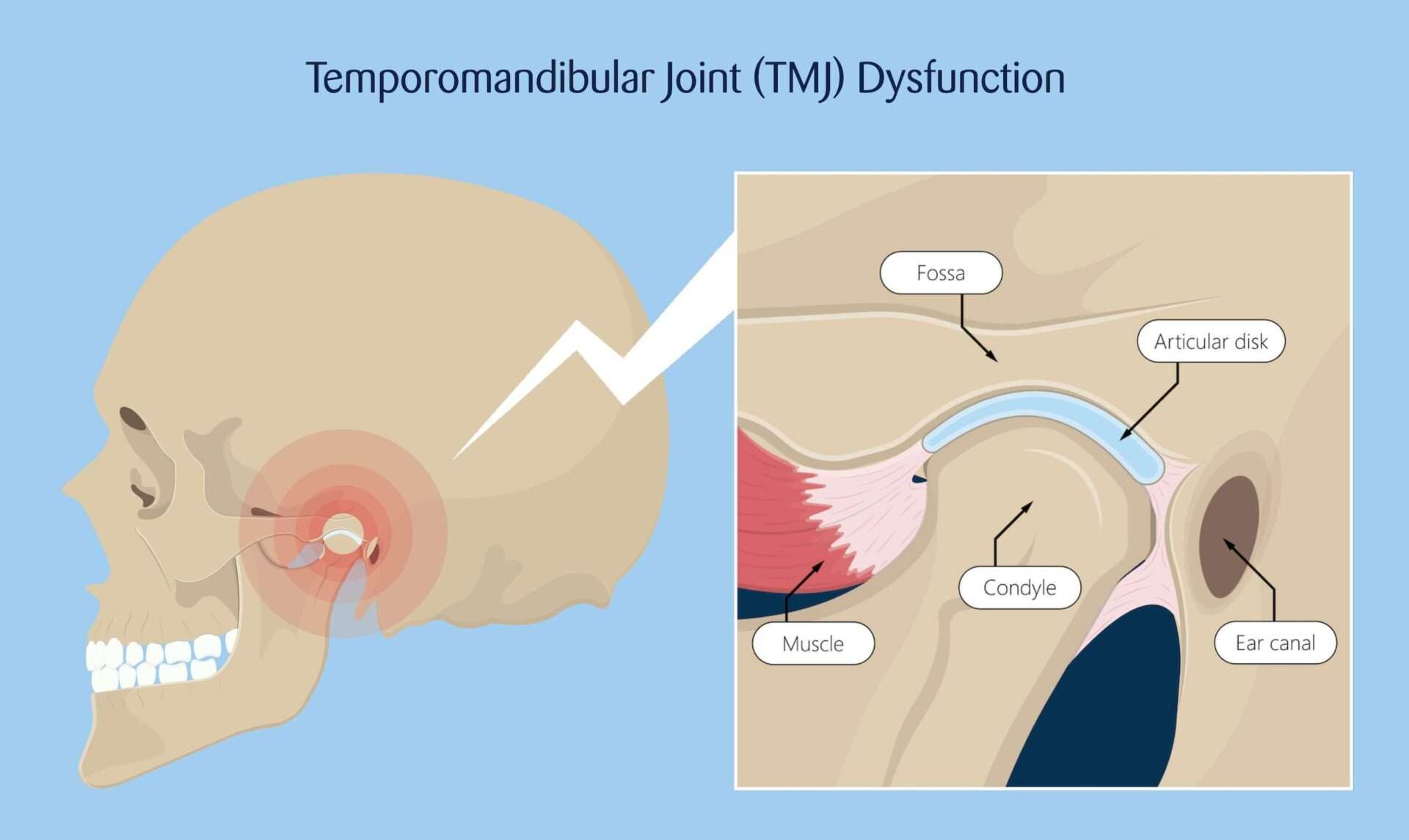 Why Does My Jaw Hurt When I Wake Up? - MyHealthGeek