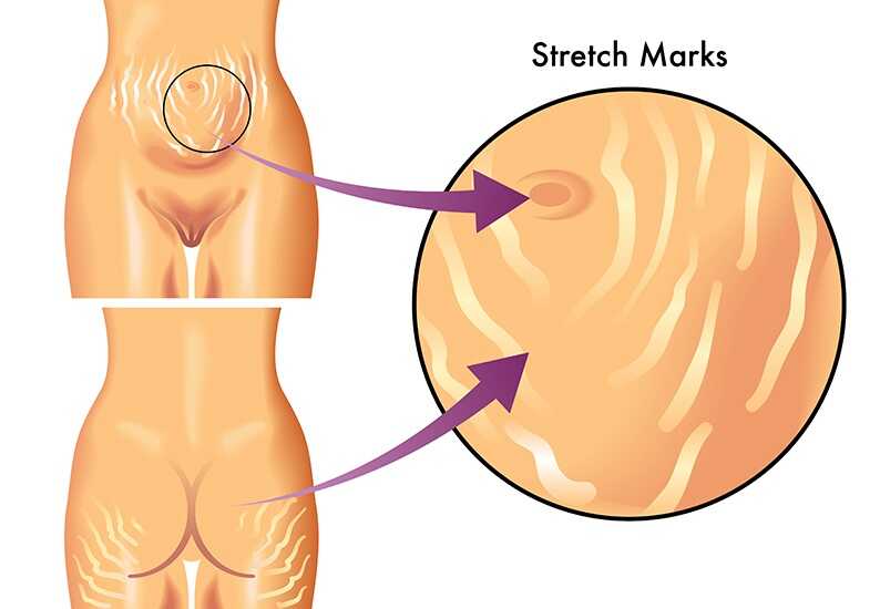 Can Tight Pants Cause Stretch Marks?