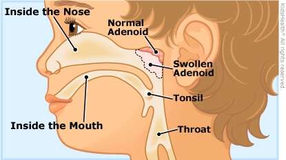 adenoidalHypertrophy a enIL