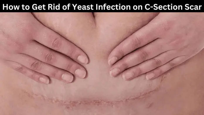 how to get rid of yeast infection on c-section scar