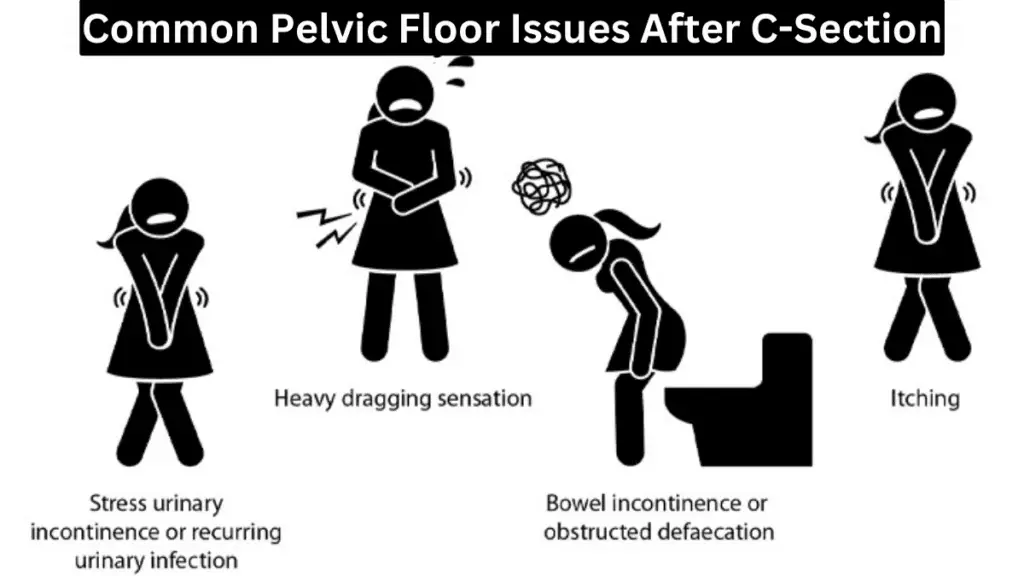 Common Pelvic Floor Issues After C-Section