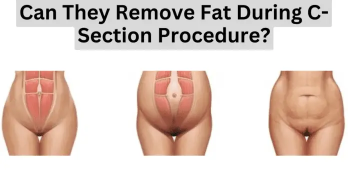 Can They Remove Fat During C-Section Procedure?