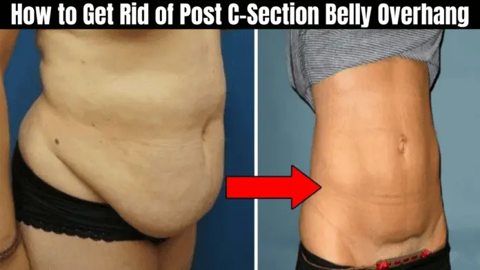 How to Get Rid of Post C-Section Belly Overhang