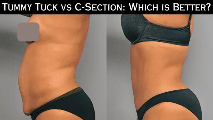 Tummy Tuck vs C-Section: Which is Better?