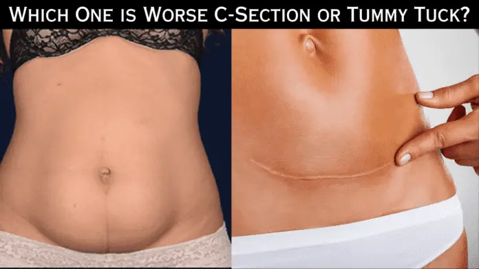 Which One is Worse C-Section or Tummy Tuck?