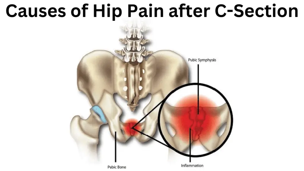 Causes of Hip Pain after C-Section