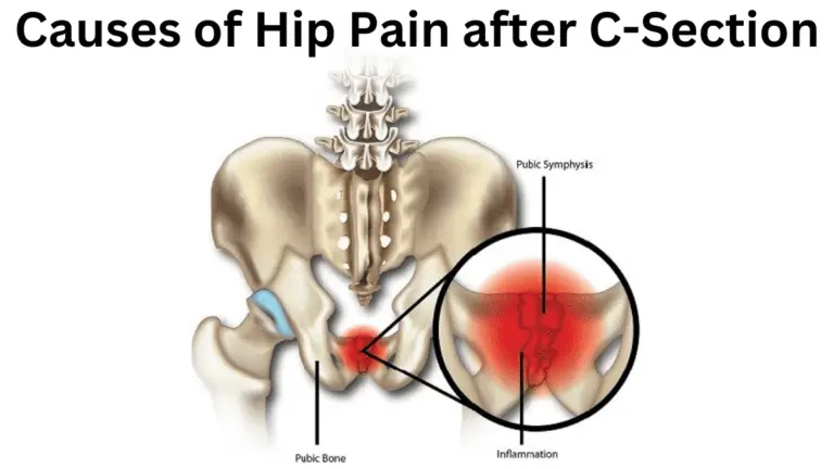 coping-with-hip-pain-after-c-section-causes-symptoms-and-treatment