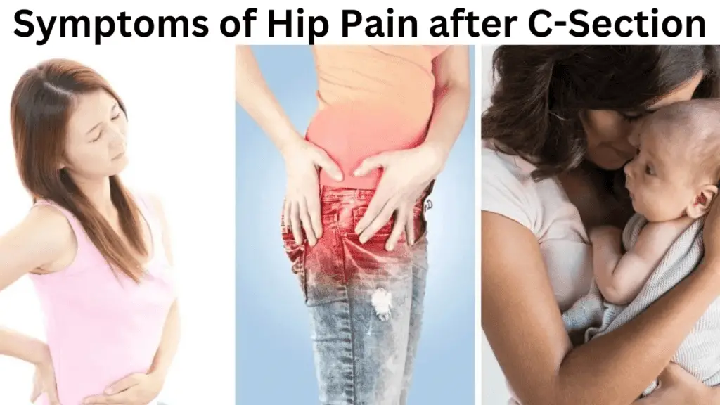 Symptoms of Hip Pain after C-Section