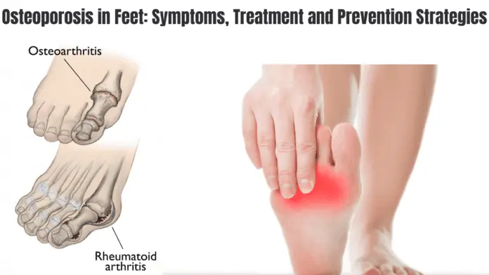 Osteoporosis in Feet