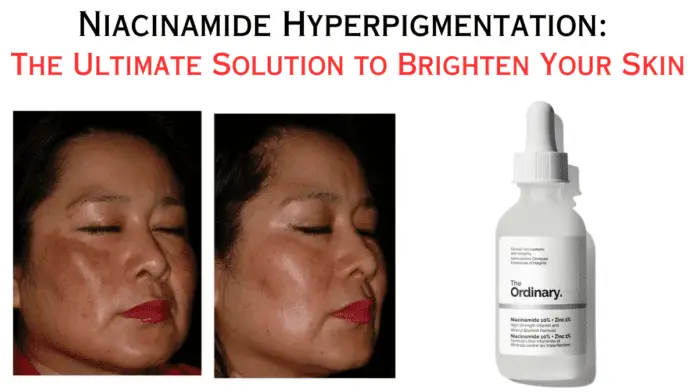 Niacinamide Hyperpigmentation: The Ultimate Solution to Brighten Your Skin