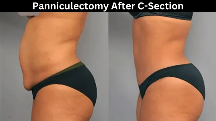 Panniculectomy After C-Section