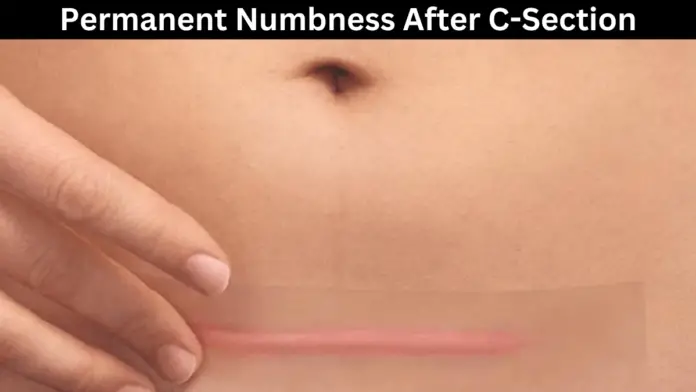 Permanent Numbness After C-Section