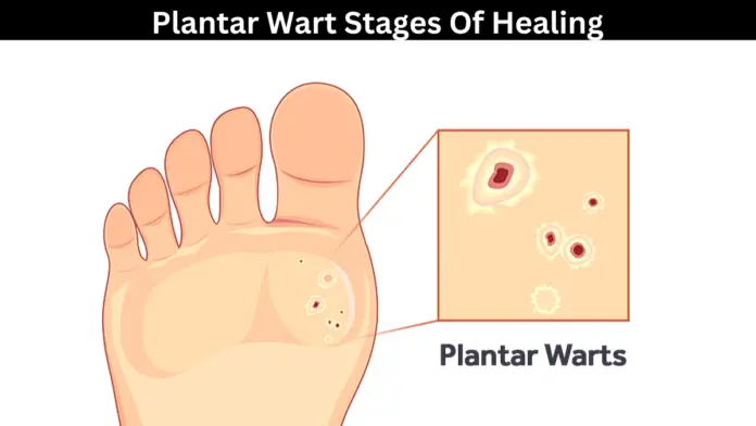 Plantar Wart Stages Of Healing