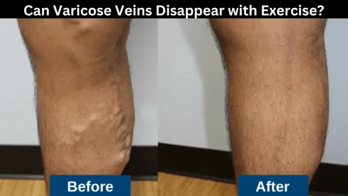 Can Varicose Veins Disappear with Exercise?