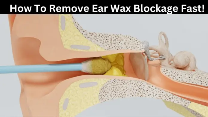 How To Remove Ear Wax Blockage Fast!