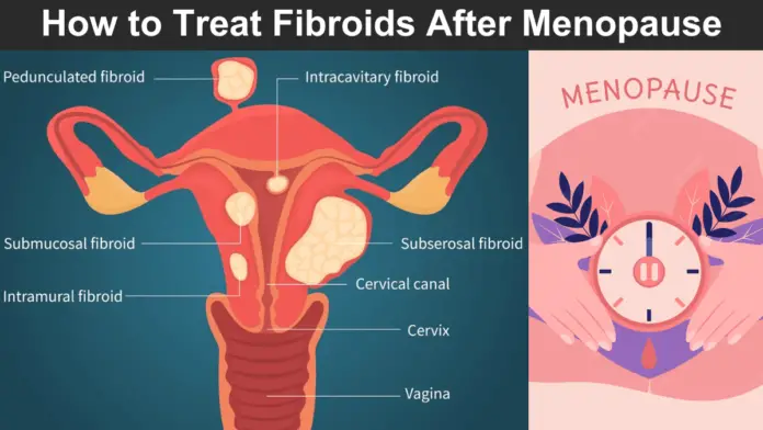 How to Treat Fibroids After Menopause