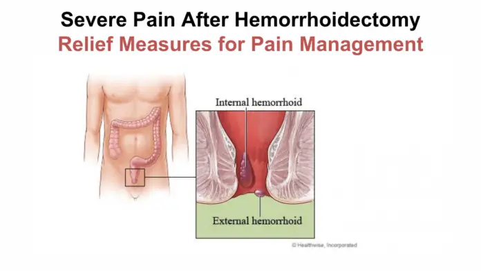 Severe Pain After Hemorrhoidectomy: Relief Measures for Pain Management