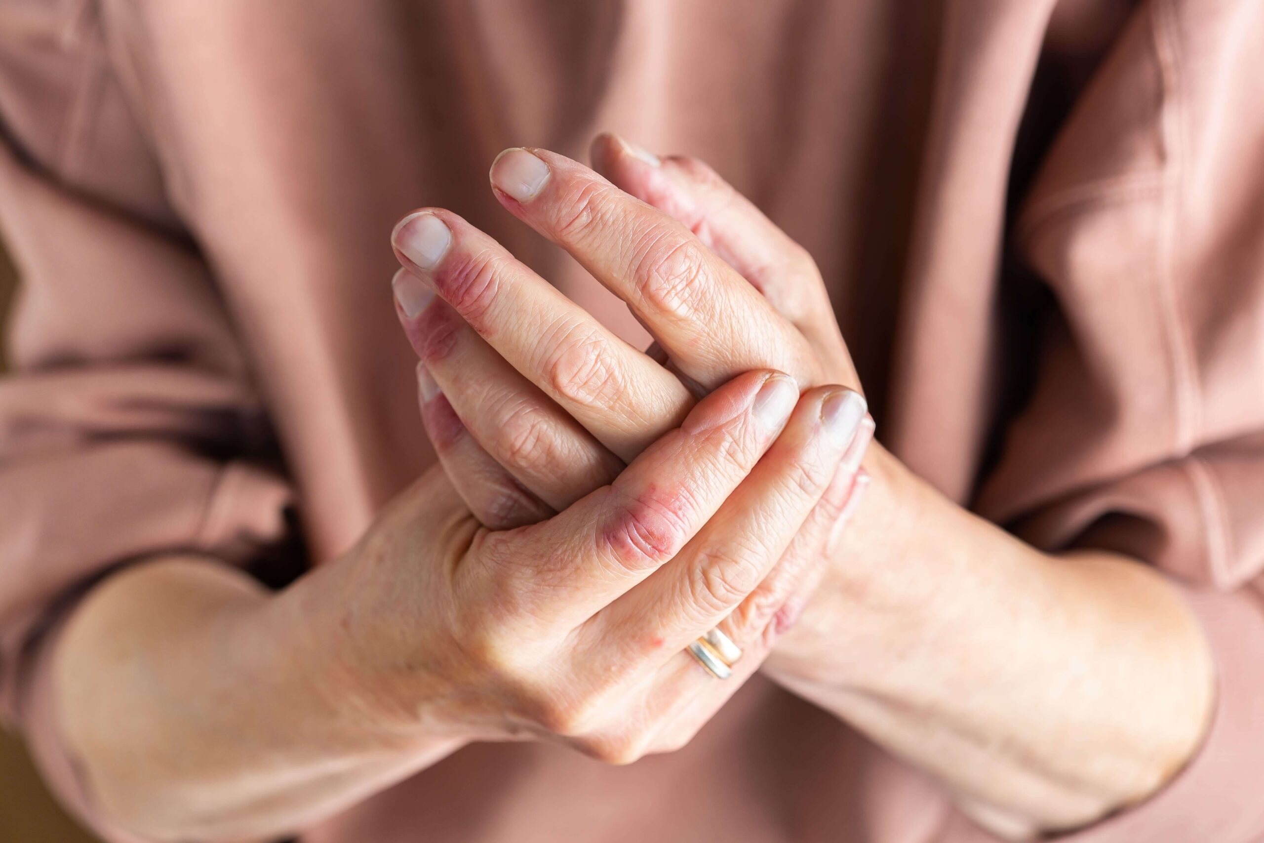 Does Lyrica Help with Arthritis Pain?