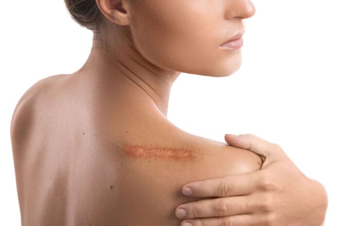 How to Get Rid of Scar Tissue